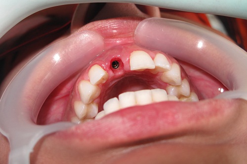 Больно ли удалять зубы мудрости с верхней или нижней челюсти?